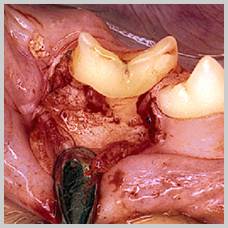 Flap exposing diseased 409 in the cat