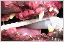 Generalised severe gingival hyperplasia