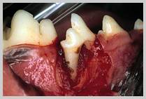 Severe/total attachment loss of mesial root 408