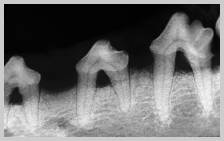 Radiograph showing up to 50% bone loss