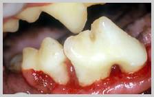 Up to 50% attachment loss with active inflammation