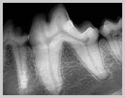 Radiograph of normal periodontium