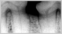 Radiograph showing less than 25% bone loss horizontally