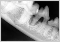 Radiograph showing more than 50% attachment loss of mesial root