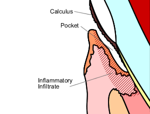 Healing pocket 1