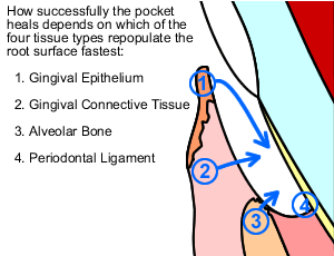 Healing pocket 2