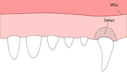 Free gingival graft 1