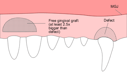 Free gingival graft 2
