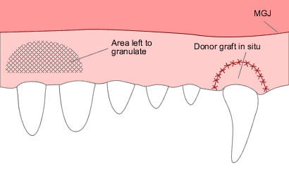 Free gingival graft 3
