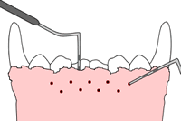 Gingivectomy 1