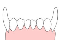Gingivectomy 3