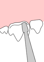 Odontoplasty 1