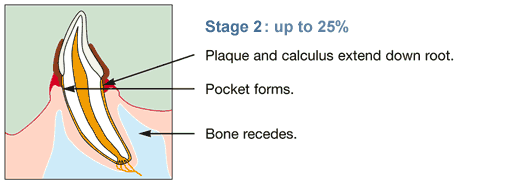 Up to 25% attachment loss in tooth
