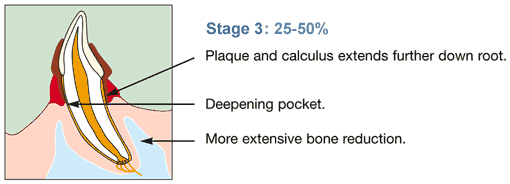 25-50% attachment loss in tooth