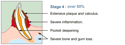 Over 50% attachment loss in tooth