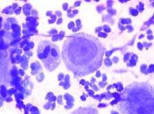 Acanthocytes and neutrophils in an impression smear of blisters in feline