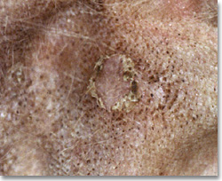 Comedones and epidermal collarettes in a case of superficial pyoderma following unwise use of glucocorticoids in an atopic dog