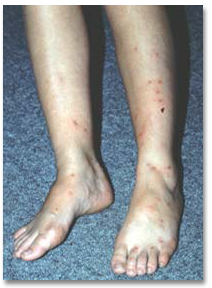 flea bites on ankles