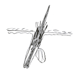 Follicular cast