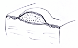 Pustule