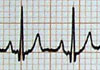 ECG chart