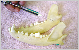 Intra-oral regional blocking of the mandibular teeth