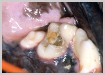 Severe class 1 carie in occlusal pit of 109