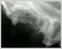 Retained root tip from extracted upper premolar 4