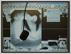 Digital radiographs and CCD/CMOS sensor plate