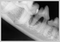 Radiograph of 408 with advanced attachment loss of caudal root