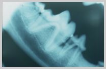 Intra-oral parallel view showing suprabony pocket interproximally between mandibular molar 1 and premolar 4