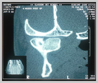 CT scan of same fractured mandibular condyle 4 weeks post-trauma
