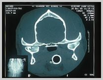 CT scan of fractured right mandibular condyle