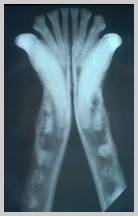 Intra-oral VD view of rostral mandible. Crowns of premolars had been snapped off using sloppy technique when extracting