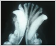 Acanthomatous epulis located buccomesial to 304
