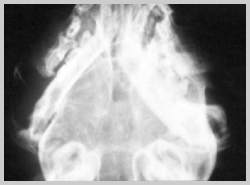 DV view of caudal cat skull  showing neoarthrosis of both mandibular condyles