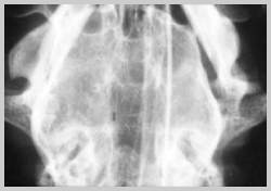 DV view of caudal dog skull clearly showing right mandibular condyle luxated rostrally out of the TMJ