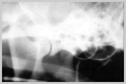 Radiograph showing joint space 