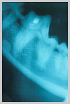 Class 1 carie (filled) affecting caudal occlusal pit of mandibular molar 1