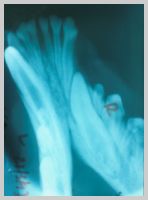 Impacted right lower canine tooth