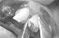Tooth extraction chapter